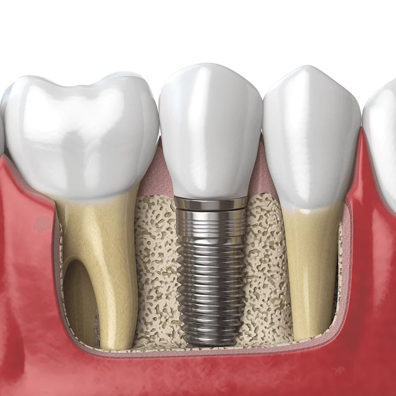 Implant1 Implant1