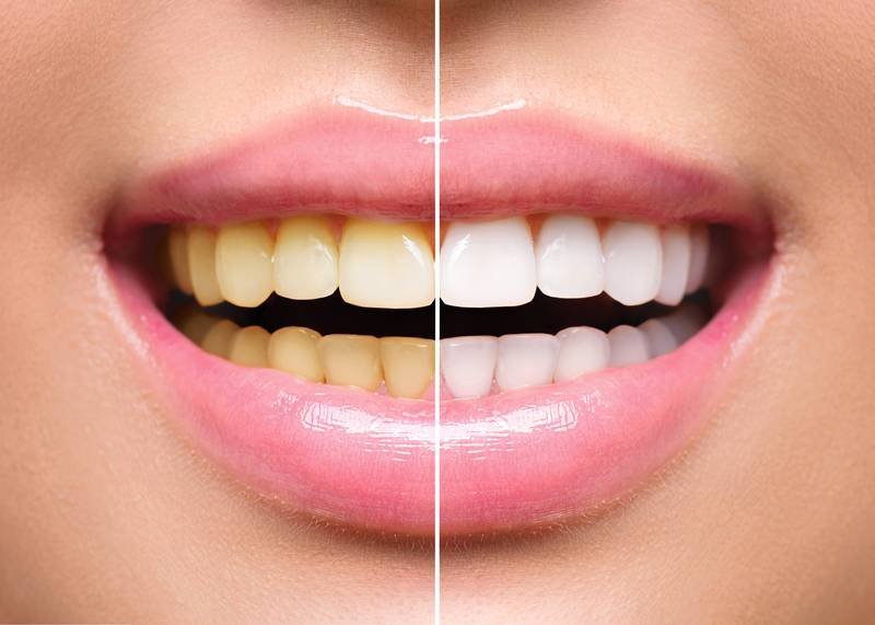 Teeth Whitening with Braces