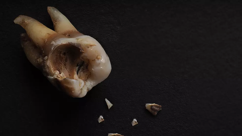 decayed teeth Tooth Decay